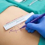 Caneta Cirúrgica Dermografica Ponta Normal Estéril - unidade